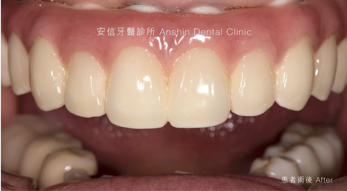 A close up of a person 's teeth and gums.