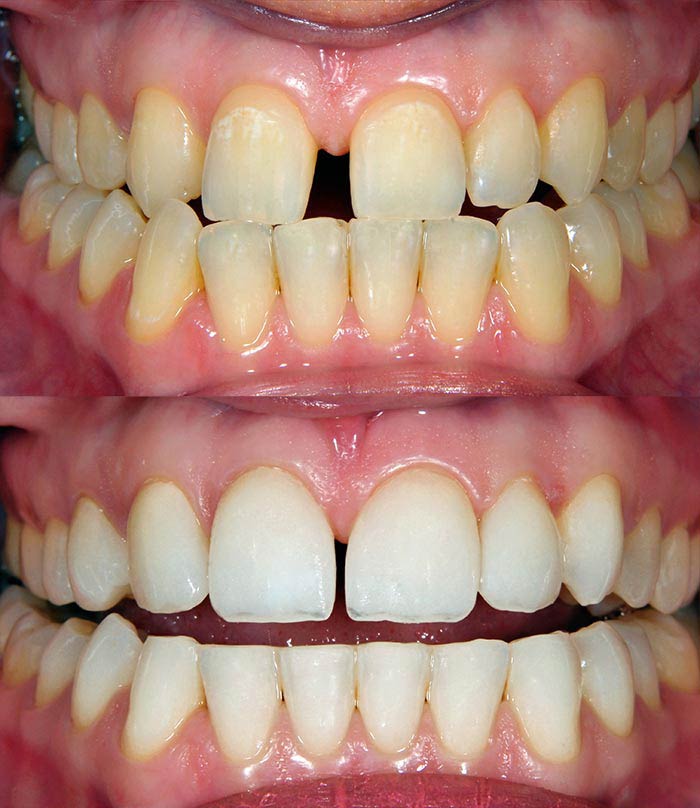 Teeth Spaces — Cosmetic Dentistry in Madisonville, KY