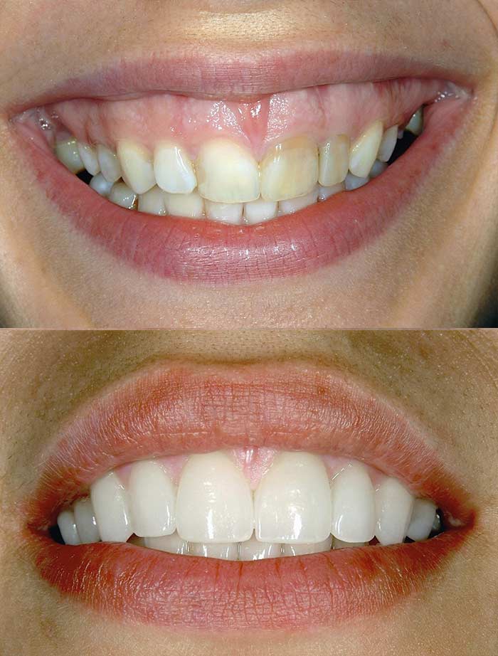 Teeth Whitening — Cosmetic Dentistry in Madisonville, KY