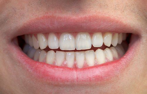Teeth— Dental Care in Madisonville, KY