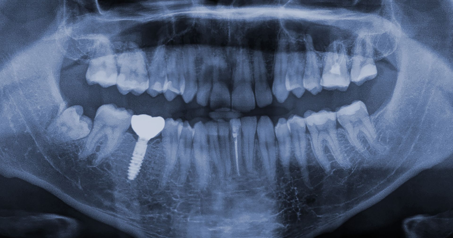 how long can dental implants last, dentist in Antioch, TN
