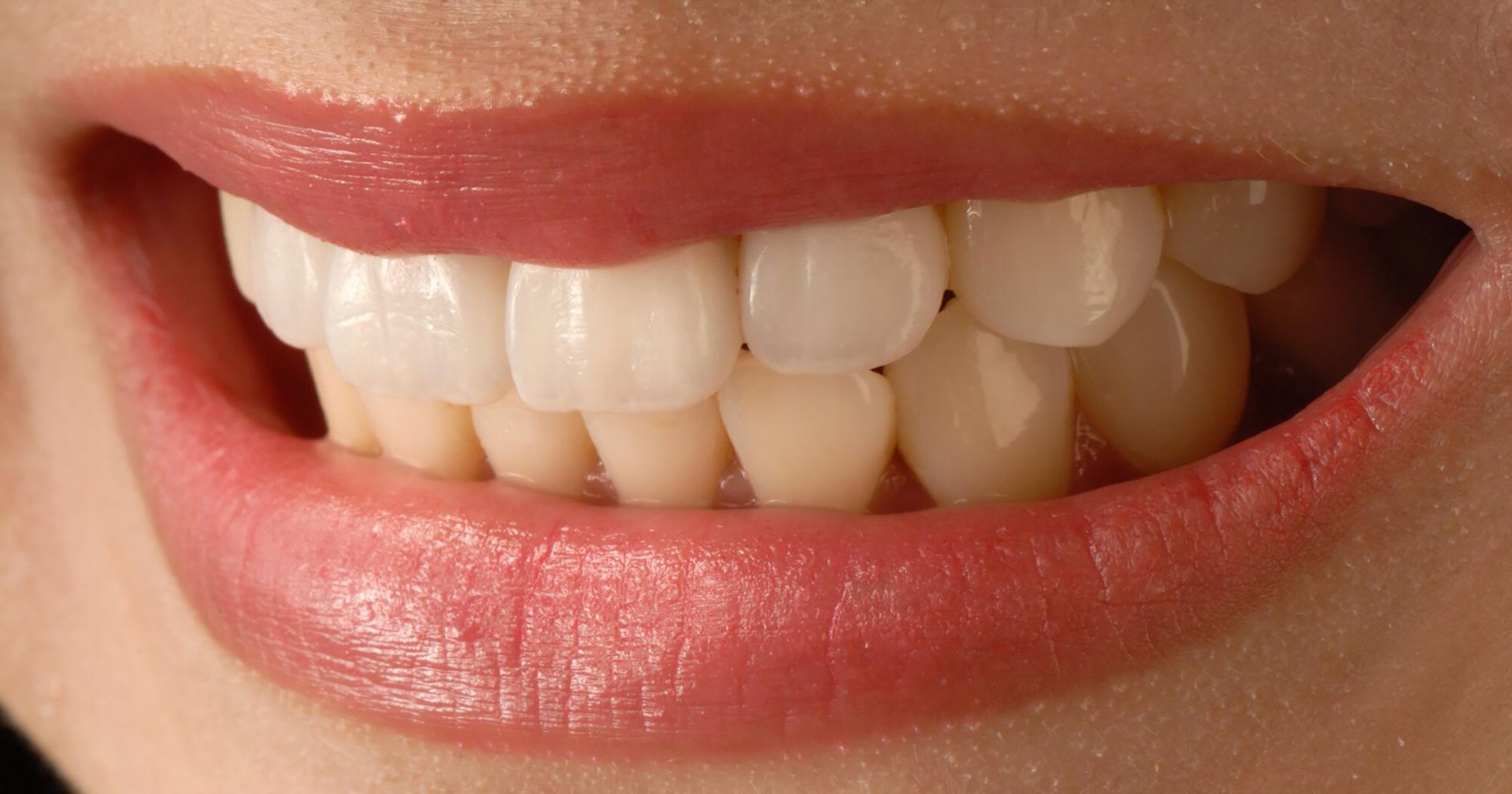 composite vs porcelain veneers