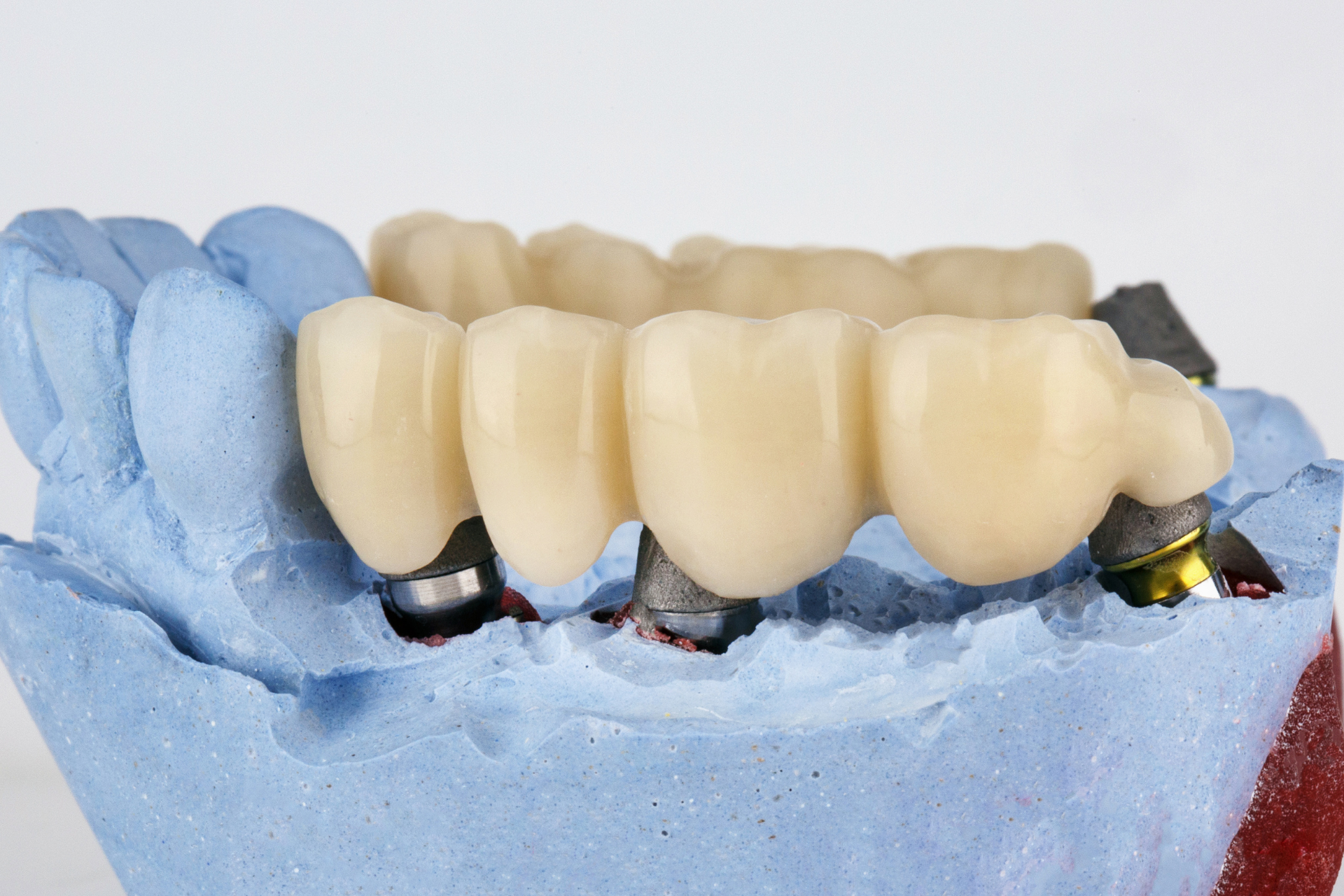 Model of dental implants in a pink gum model with three white teeth attached to silver implants.