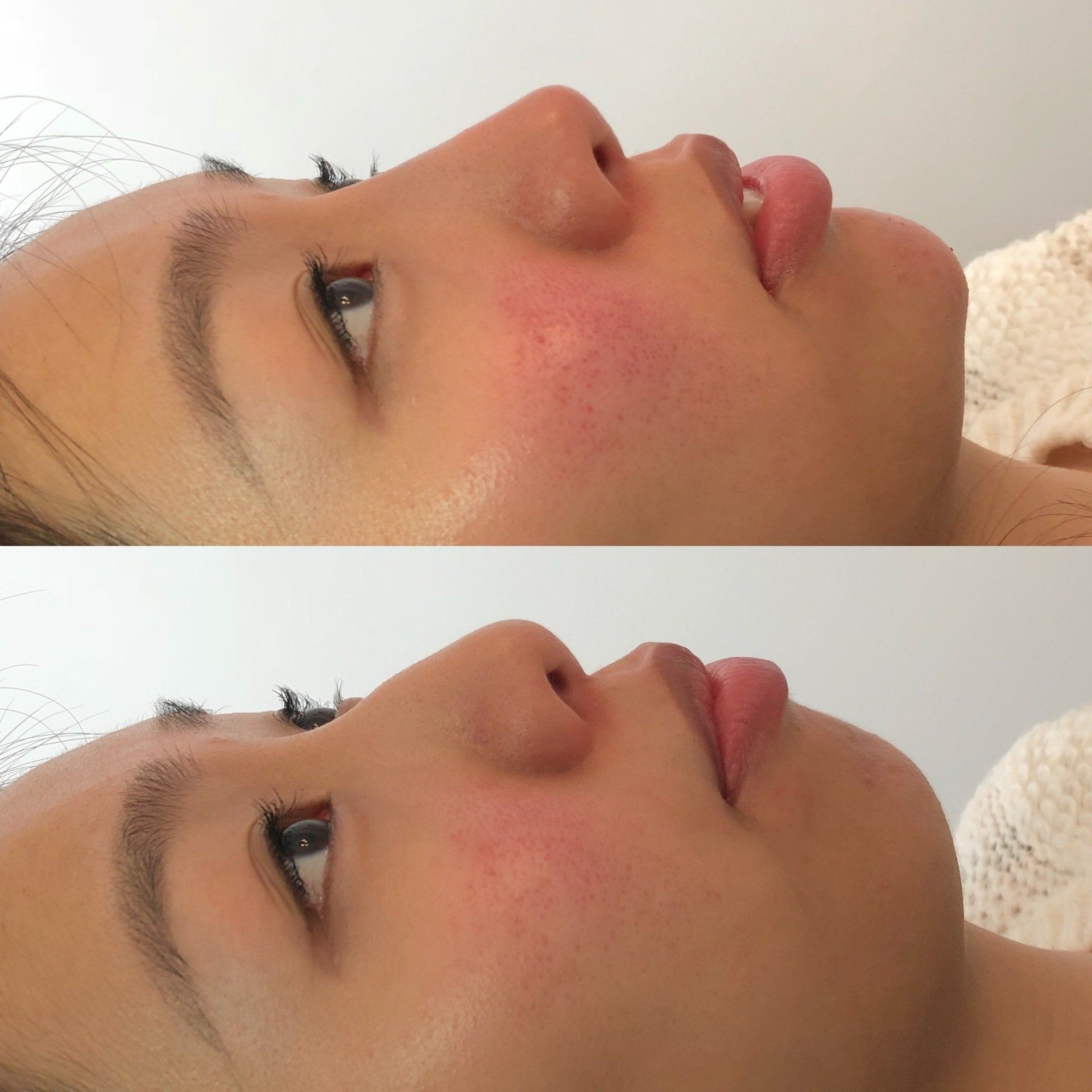 Two side-profile views of a person with a skin rash on their cheek, mouth slightly open.