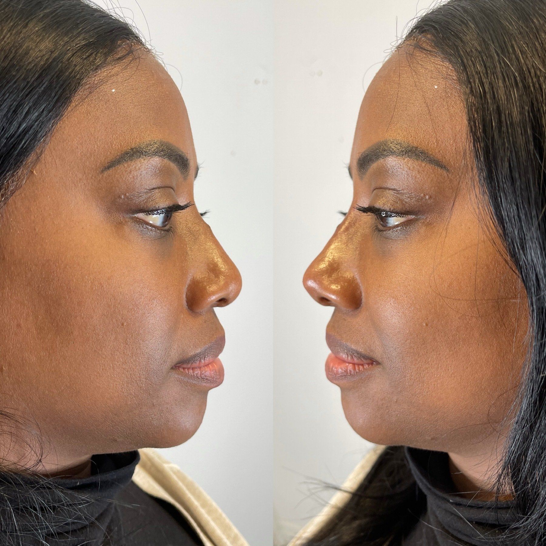 Two side-profile views of a person’s face; before and after a cosmetic procedure on the nose.