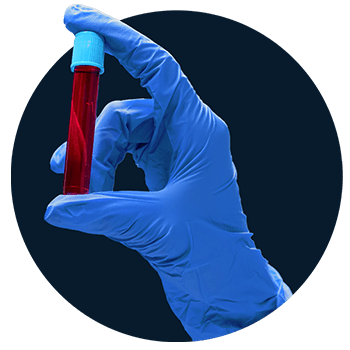 Análisis de orina para examen de varicocele