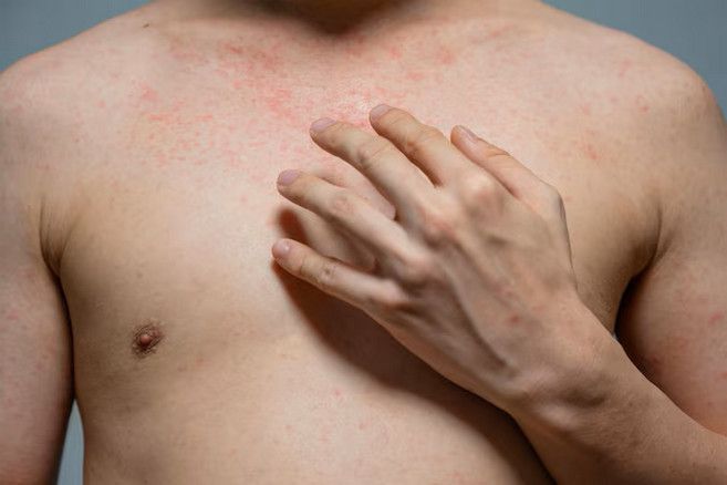 Qué es la psoriasis genital