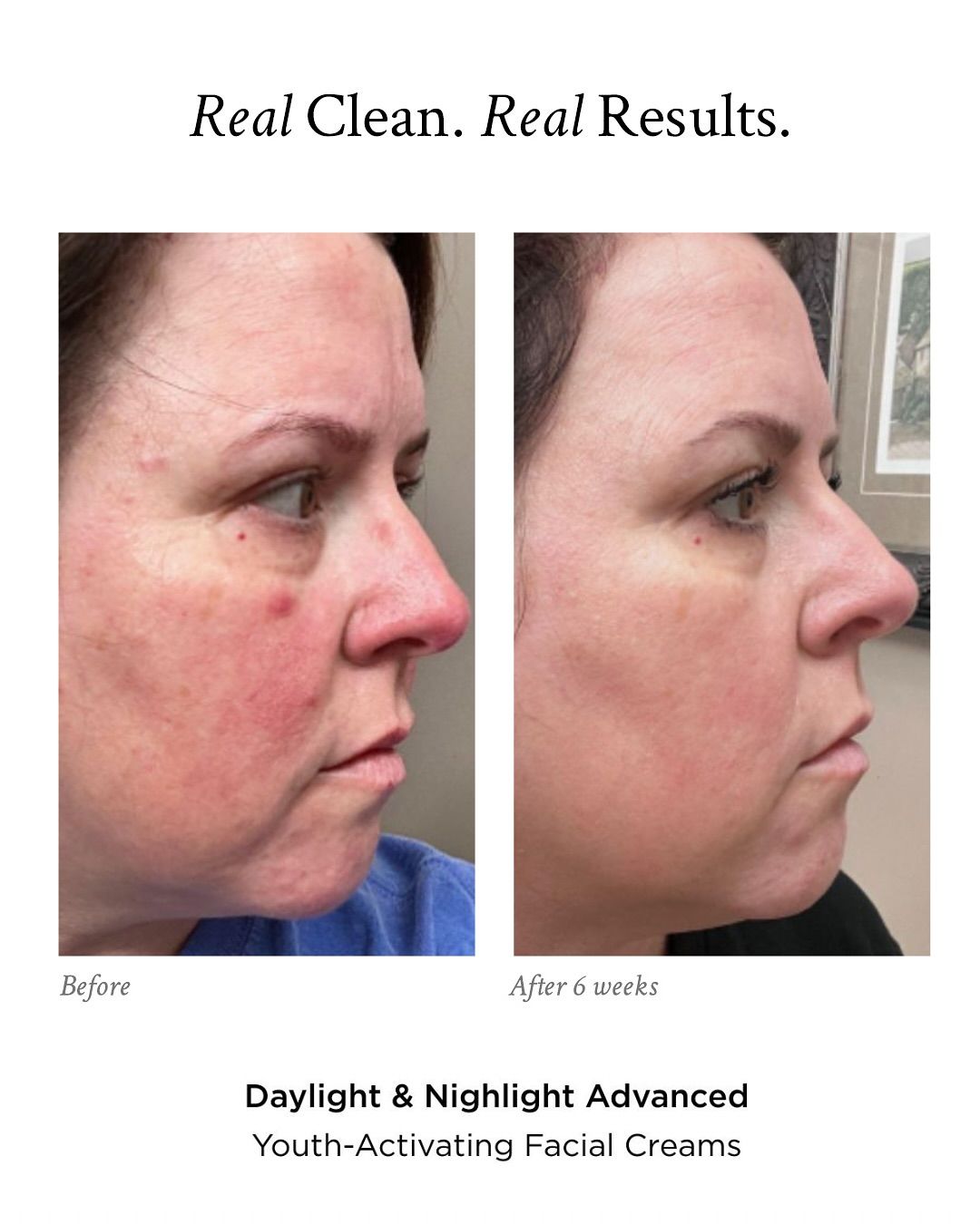 A before and after photo of a man 's face after using TruAura Skin care products