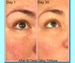 Before & After Healthy Skin Care for Freckles