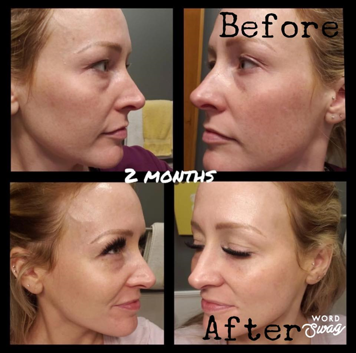 Before and After Healthy Skin Care for Melasma or Pregnancy Mask