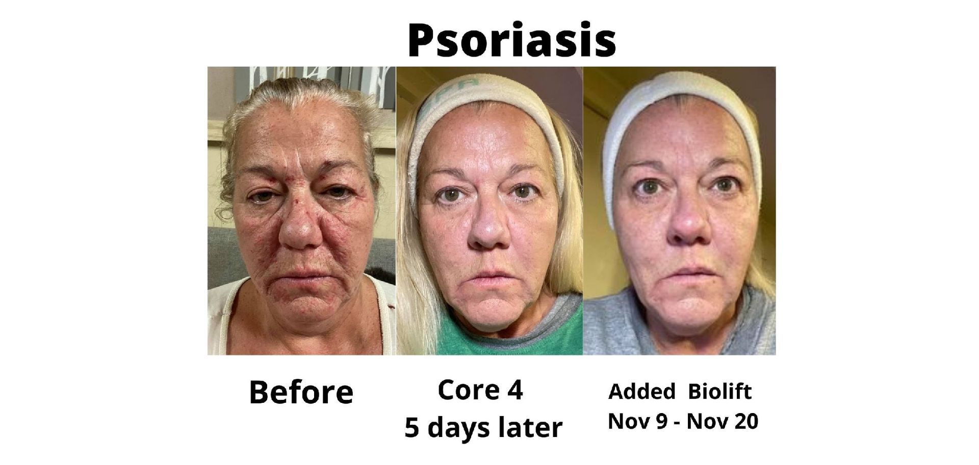 Psoriasis Skin Care Before & After