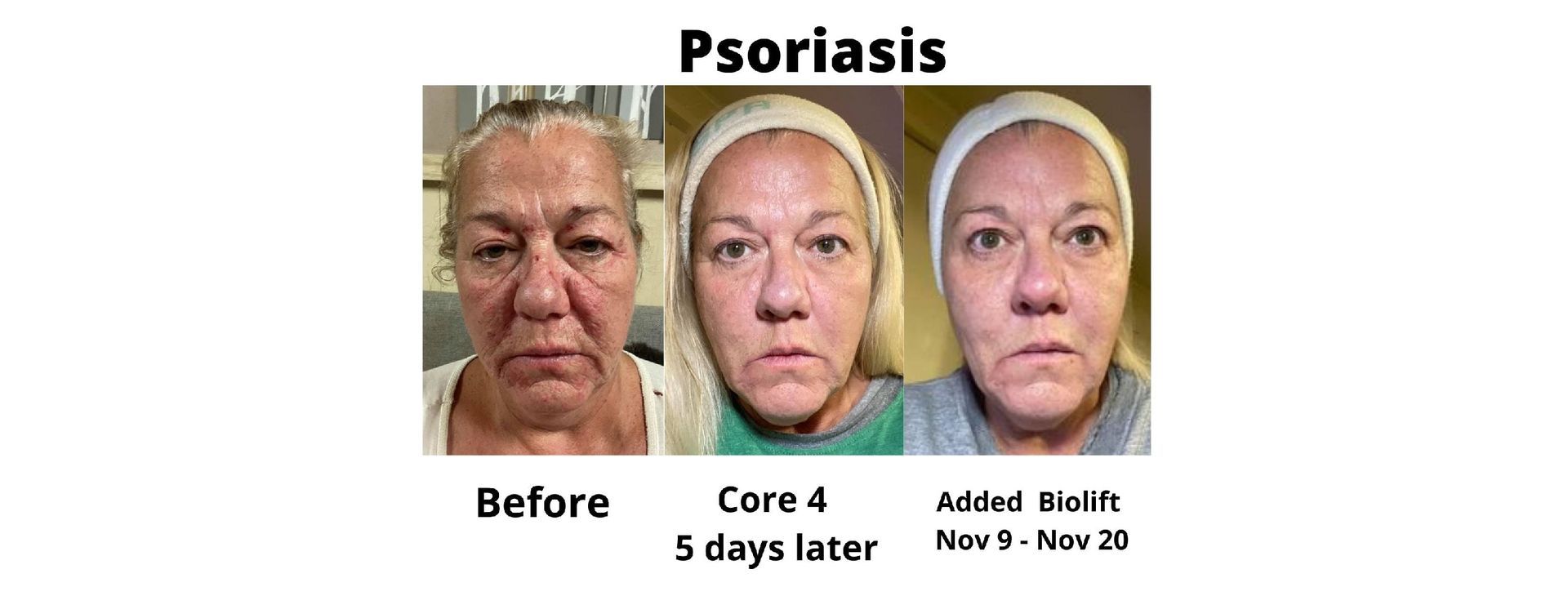 Before and After Psoriasis Skin Care Treatment