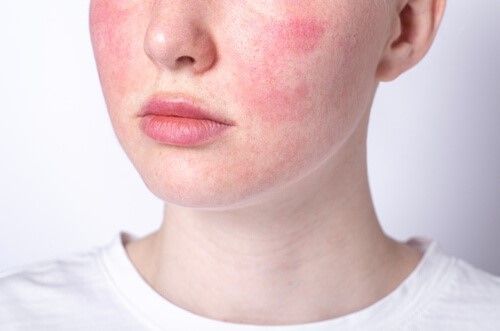 a close up of a face with red spots on it - rosacea .