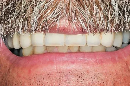 after crown implants