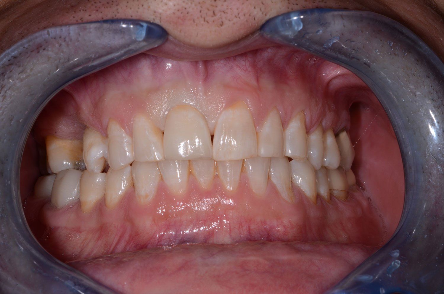 after smile makeover