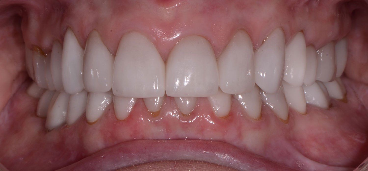 after dental crowns