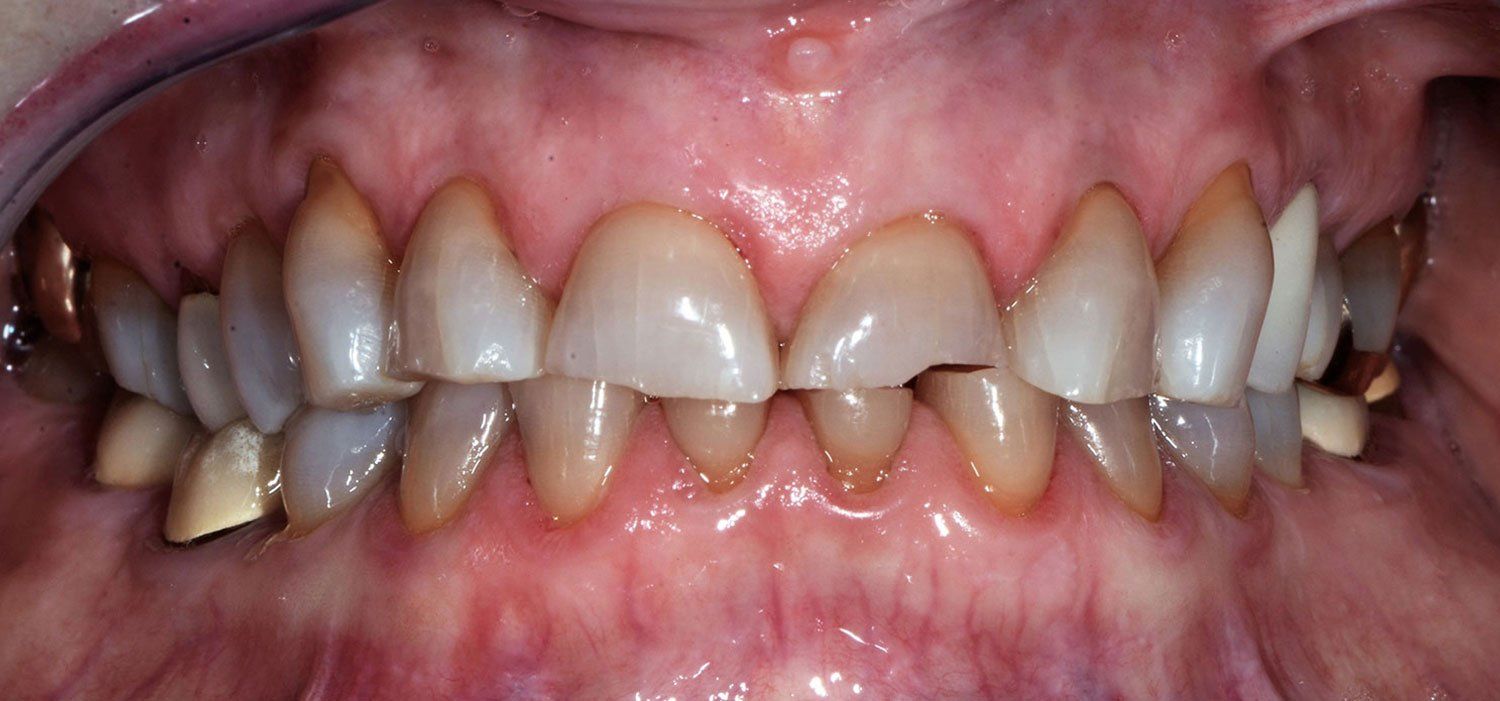 before dental crowns