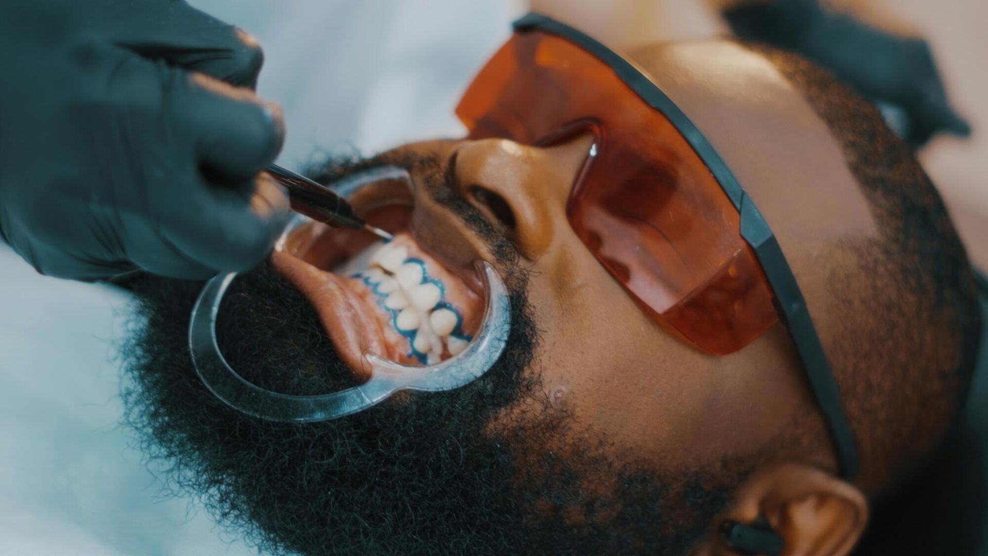 A man with a beard is getting his teeth whitened by a dentist.