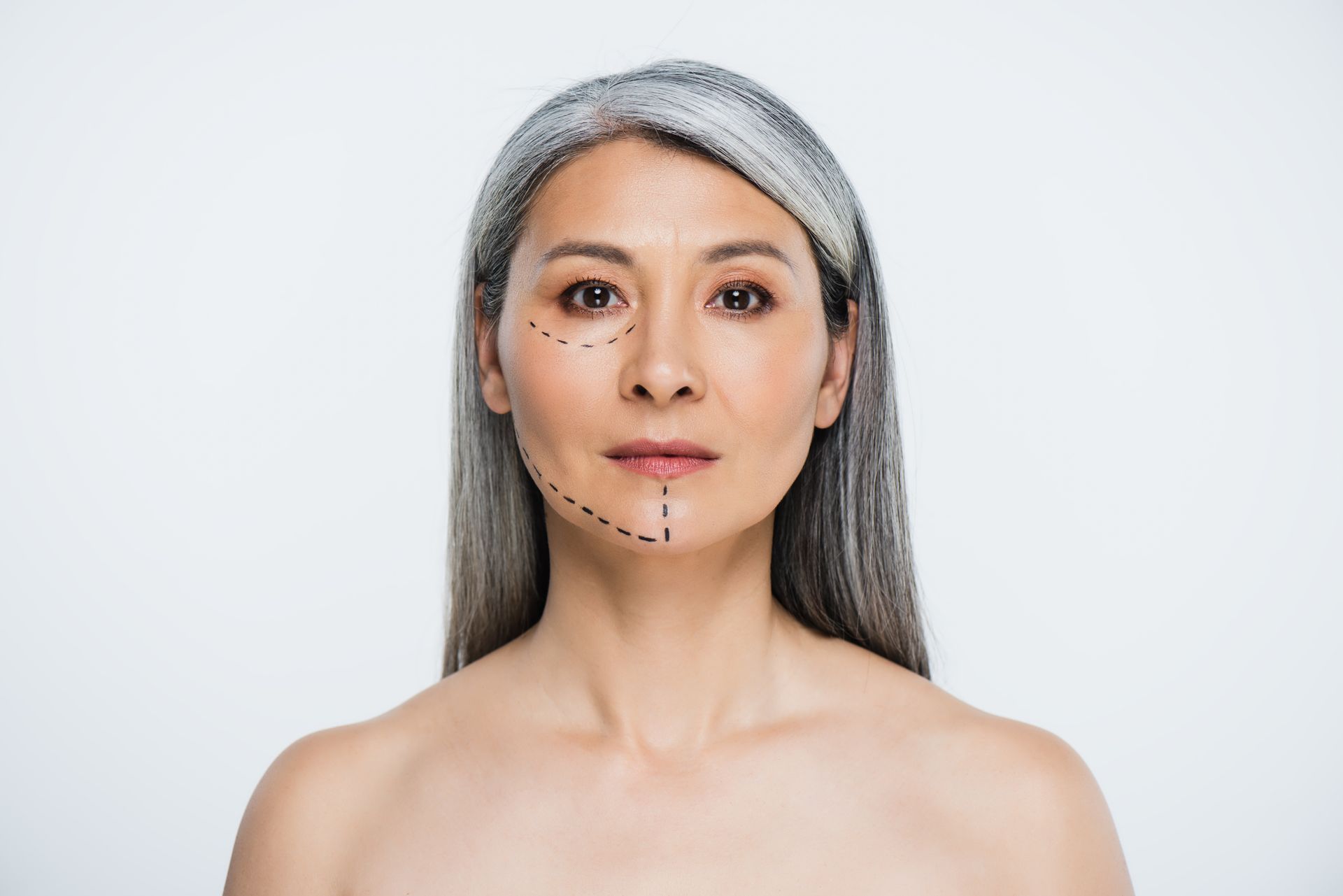 Donna con capelli grigi e segni sul viso, pronta per la chirurgia estetica.