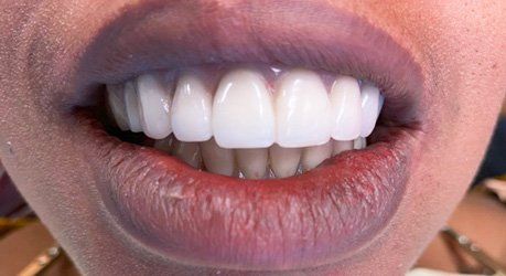 A close up of a woman 's mouth with white teeth.