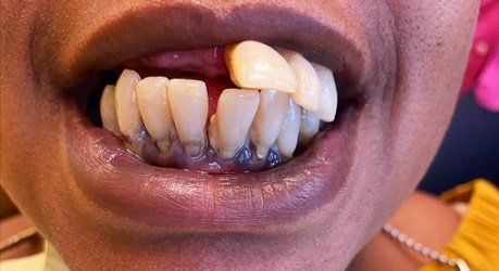 a close up of a woman 's mouth with missing teeth
