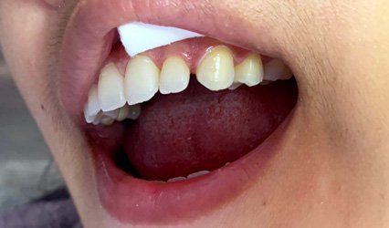 a close up of a person 's mouth with spaces in between teeth.