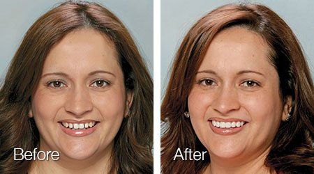 A before and after photo of a woman 's face.