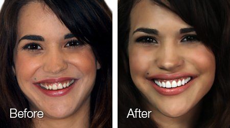 A before and after picture of a woman 's smile