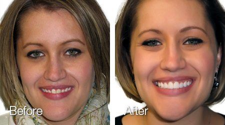 A before and after photo of a woman 's face