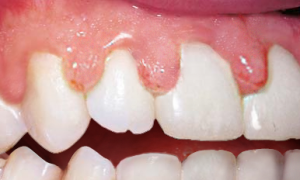 A close up of a person 's teeth and gums.