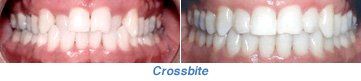 A before and after picture of a person 's teeth showing a crossbite