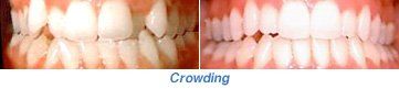 A picture of a person 's teeth before and after crowding