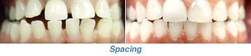 A picture of a person 's teeth before and after spacing