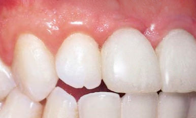 A close up of a person 's teeth and gums.