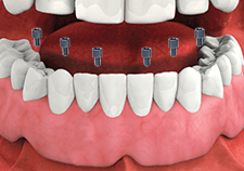 A close up of a person 's teeth with screws in them.
