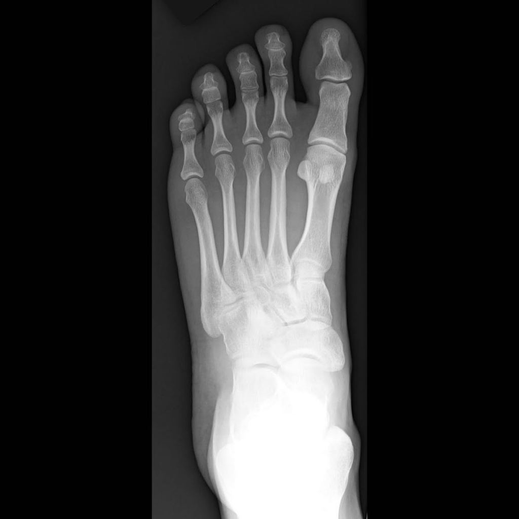 FOOT XRAY'S at Roderick Moore's Woodinville WA