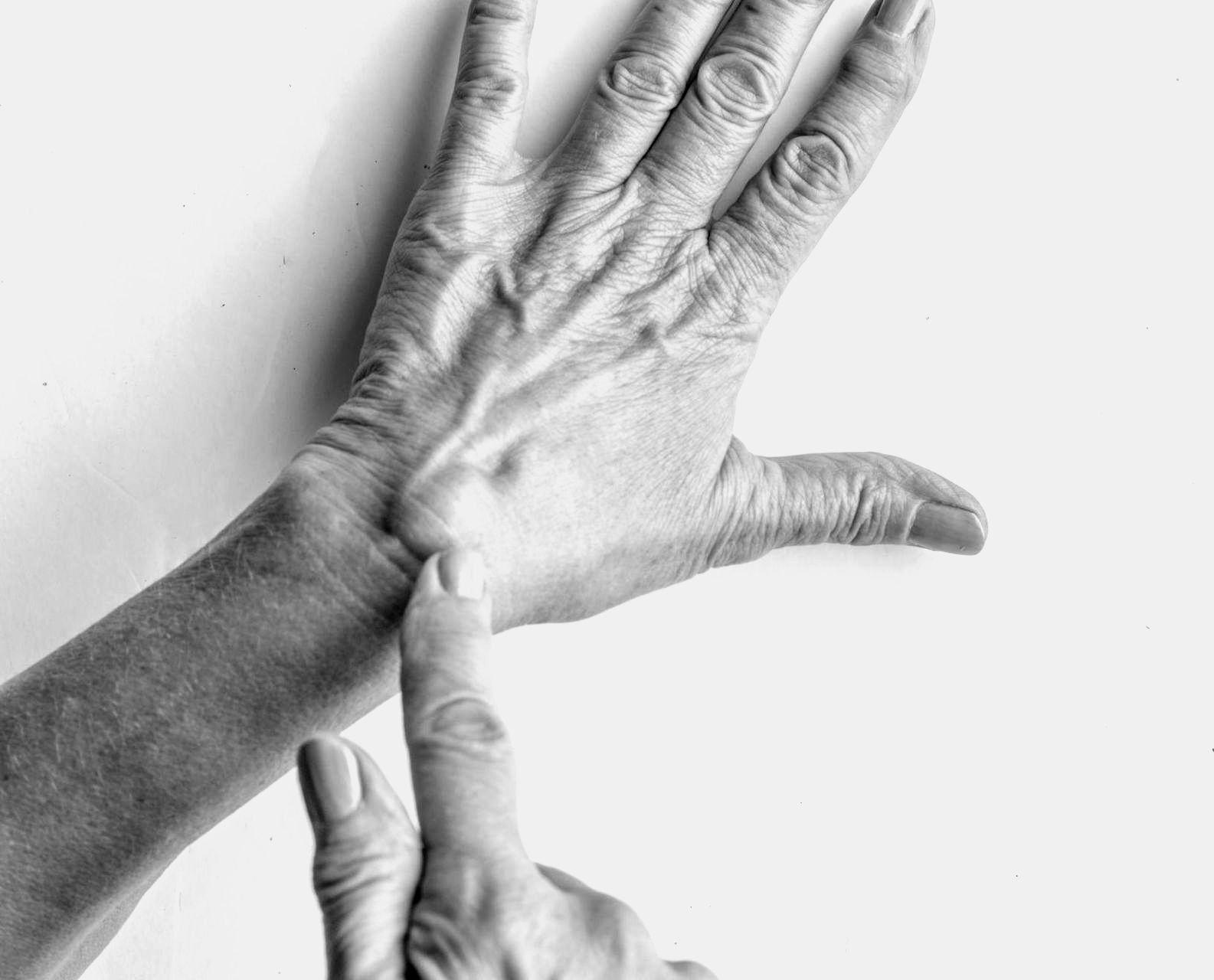 black and white closeup photo of an elderly person pointing at ganglion cyst on back of hand