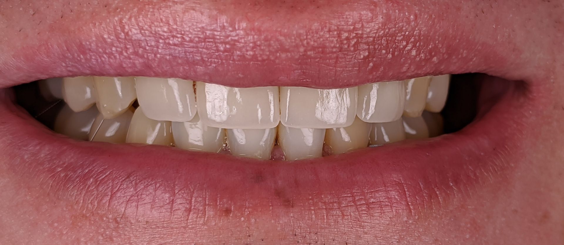 A close up of a person 's teeth with a magnifying glass.