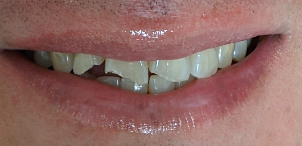 A close up of a person 's teeth with a dental mirror.