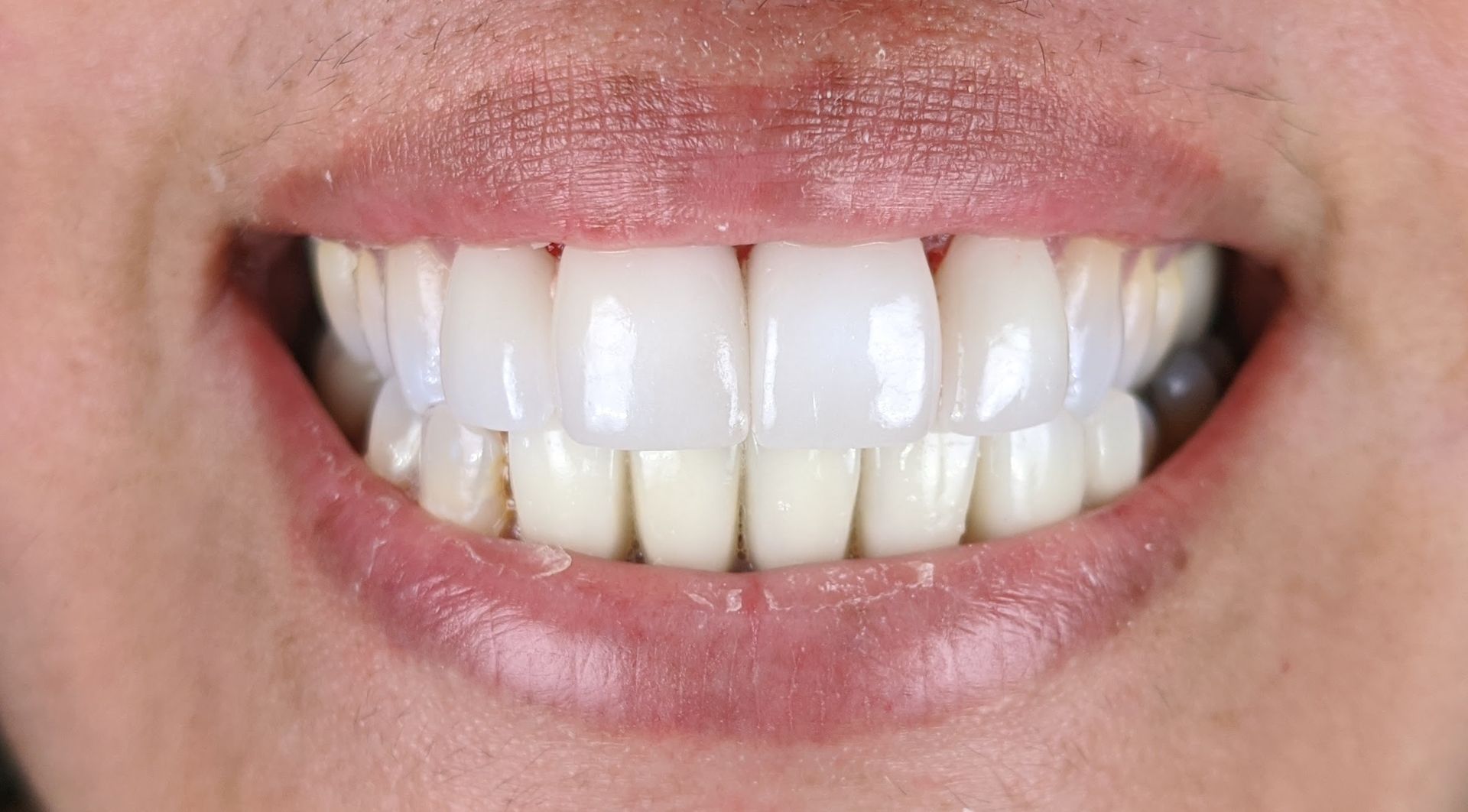 A close up of a woman 's teeth with white teeth.