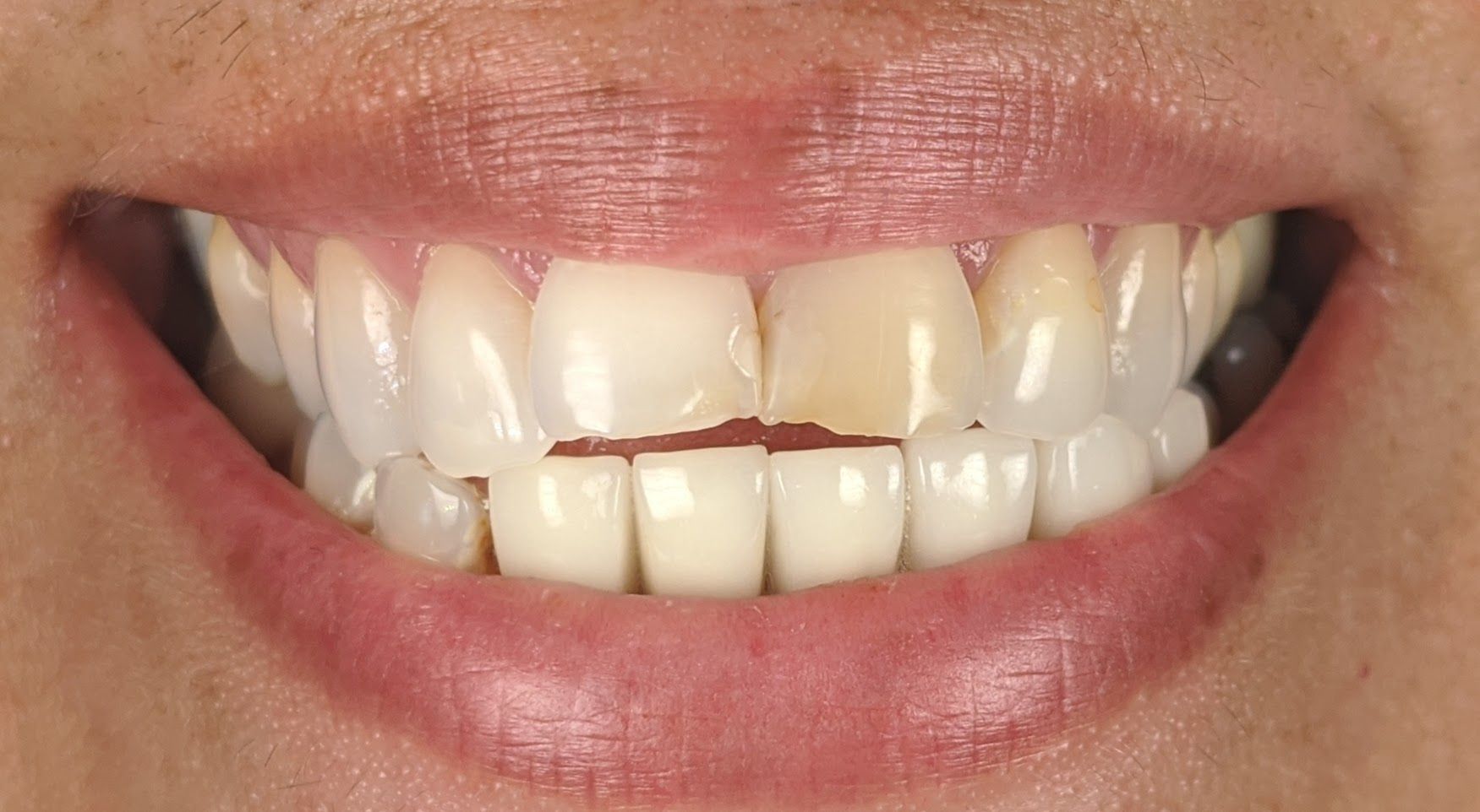 A close up of a woman 's mouth with white teeth.