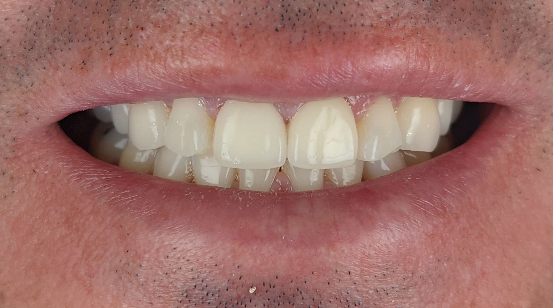 A close up of a person 's teeth with white teeth.