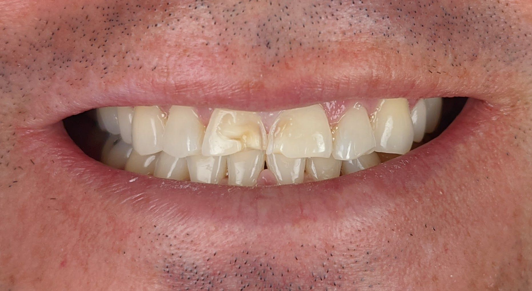 A close up of a person 's teeth with a magnifying glass.