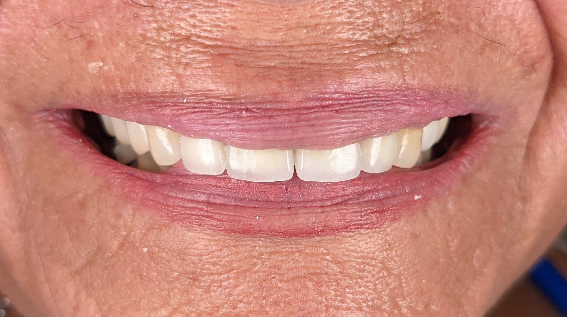 A close up of a woman 's teeth with white teeth.