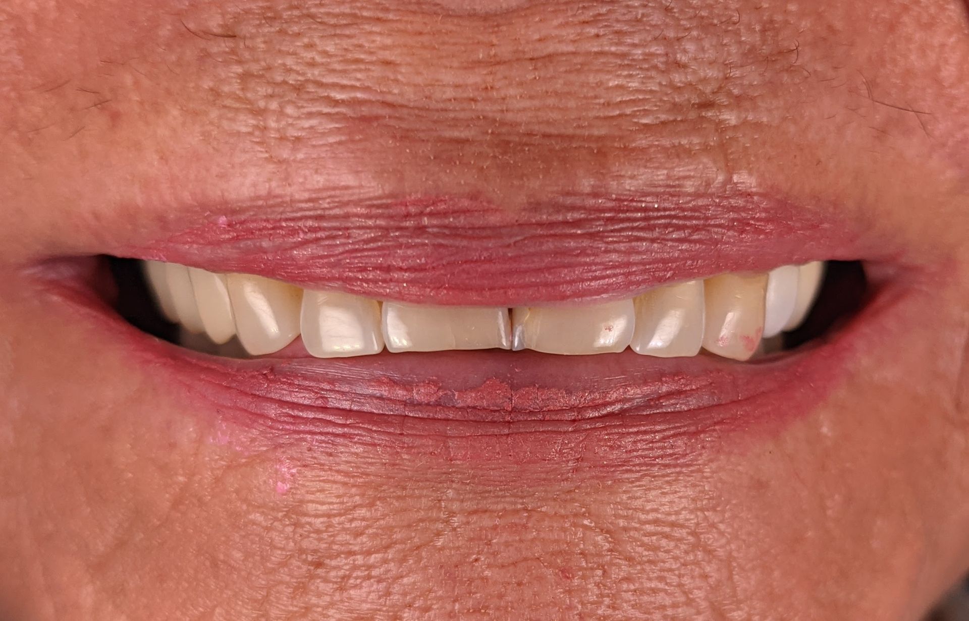 A close up of a woman 's mouth with white teeth.