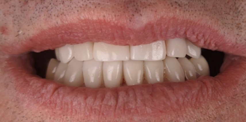 A close up of a person 's teeth with white teeth.