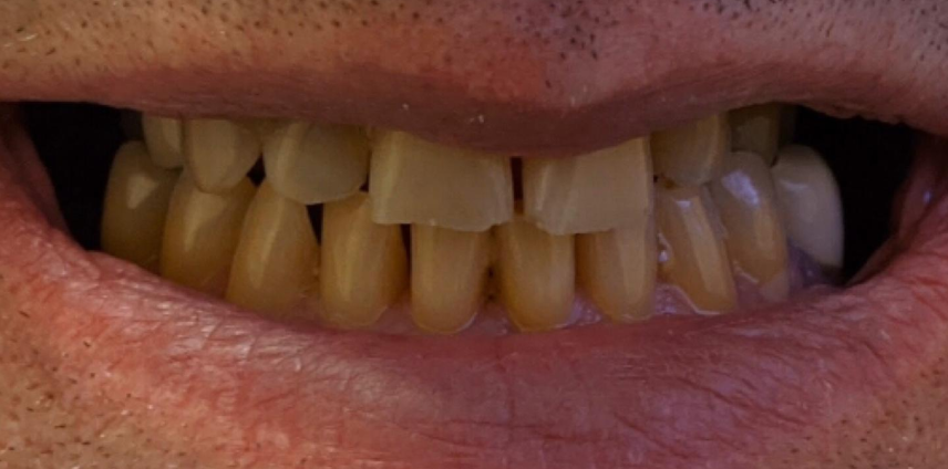 A close up of a person 's teeth with a magnifying glass.