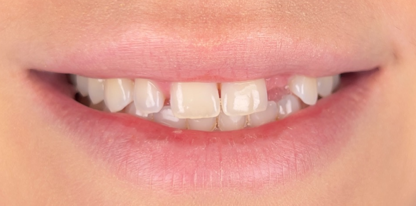 A close up of a woman 's mouth with white teeth.