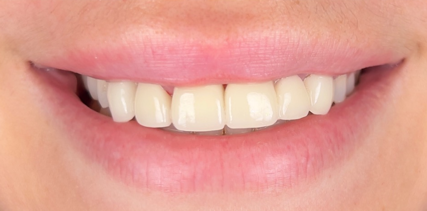 A close up of a woman 's teeth with white teeth.