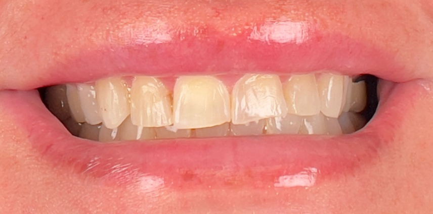 A close up of a person 's teeth with a magnifying glass.